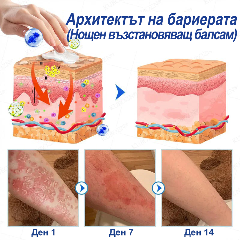 💎KUBOZN® Псориазис Дневна и Нощна Възстановяваща Система – 100% Без Стероиди Дуо за Облекчение при Плаки, Лющене и Сърбеж