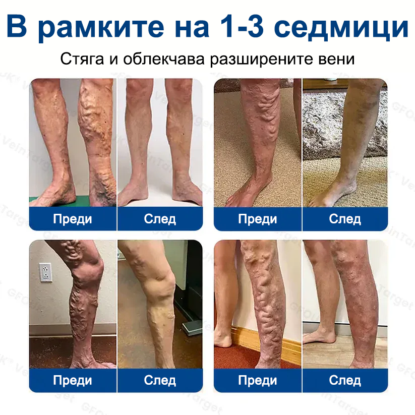 🎁GFOUK® Целенасочен микроиглен пластир за вени⚡Незабавно облекчение · Дълготрайни резултати